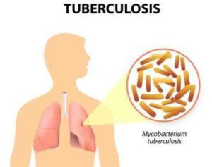 Diagnosis and Treatment of Tuberculosis
