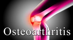 Osteoarthritis of the Knee Patient Case Study Solution